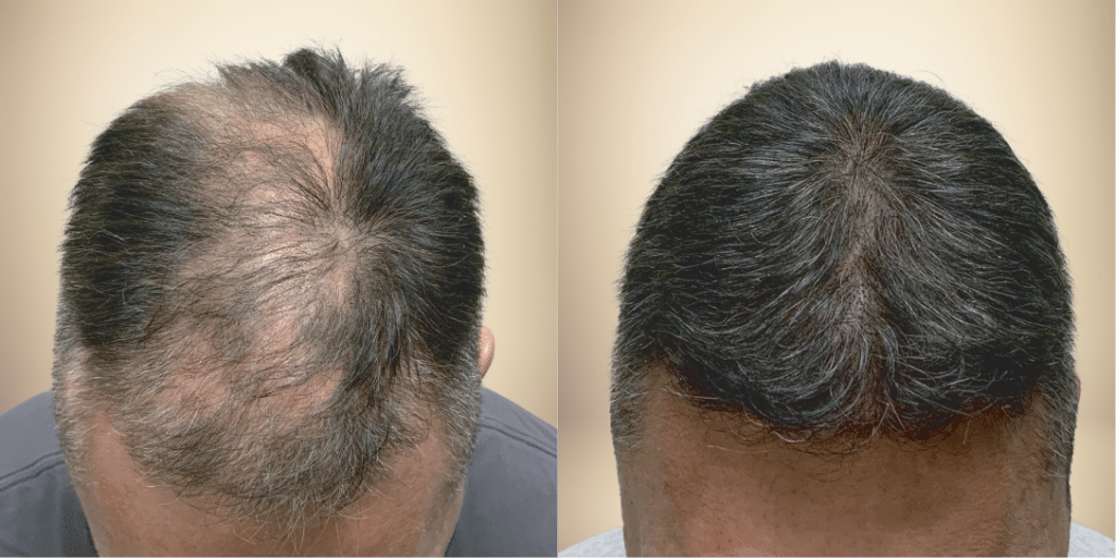 Hair Transplants Atlanta North Atlanta Hair Restoration 9793