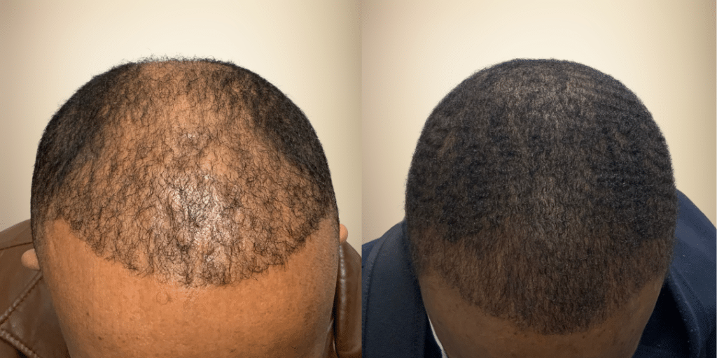 Hair Transplants Atlanta | North Atlanta Hair Restoration