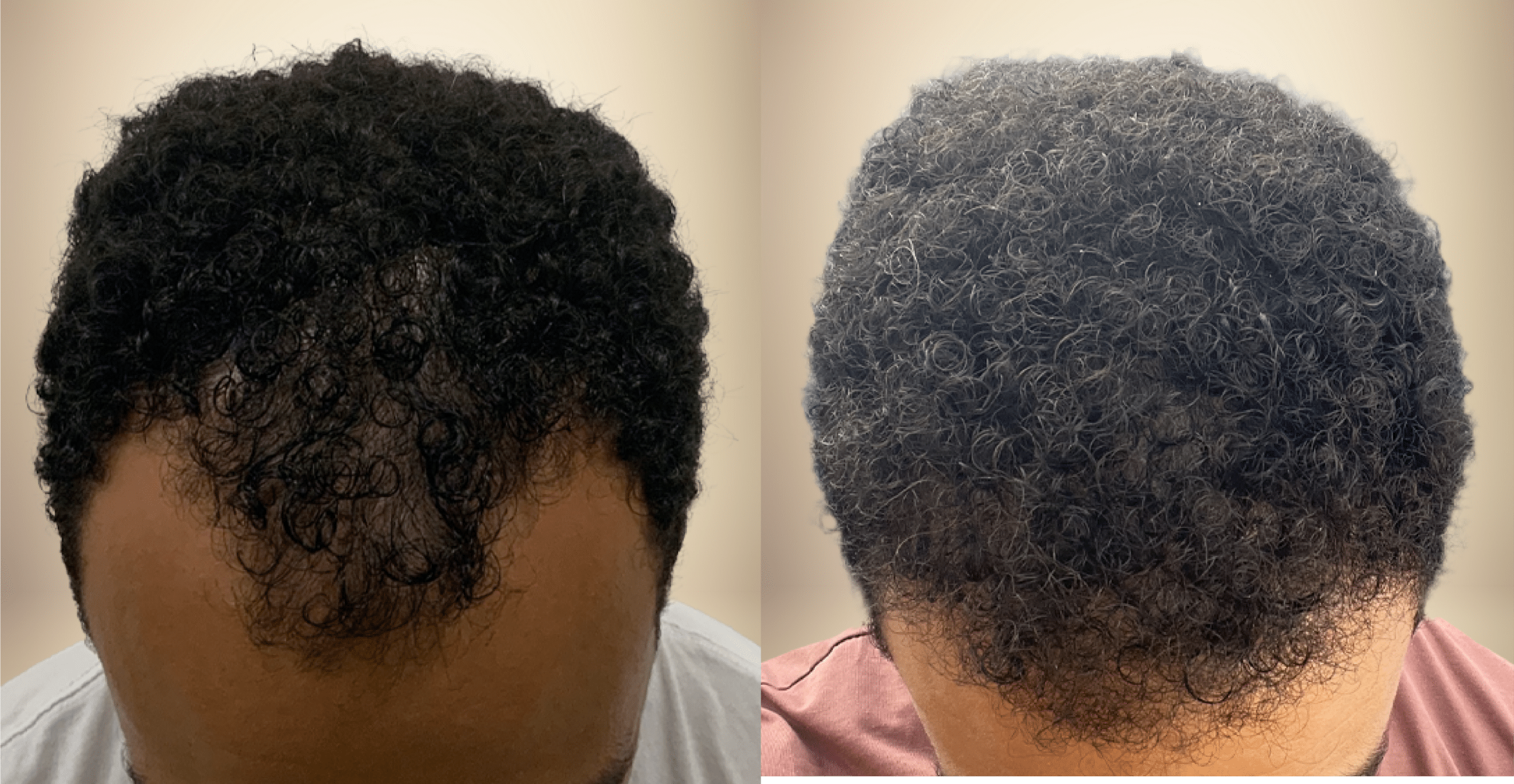 African Amercian Hair Restoration Before and After