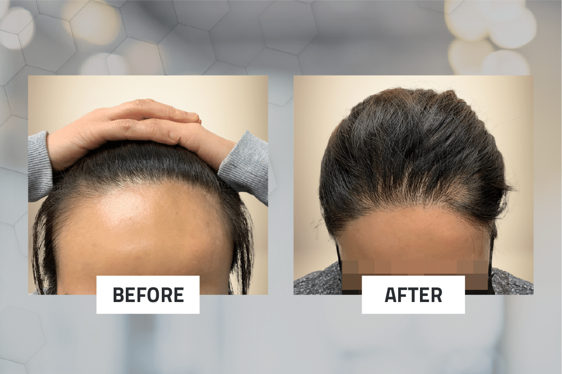 Natural-Looking Results with Hair Restoration