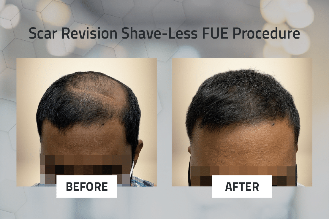 Scar Revision Shave-Less FUE Procedure