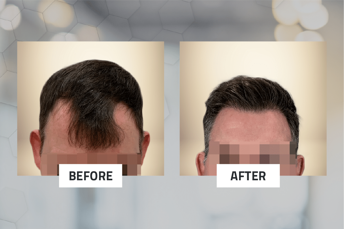 What Is Shave-Less FUE?