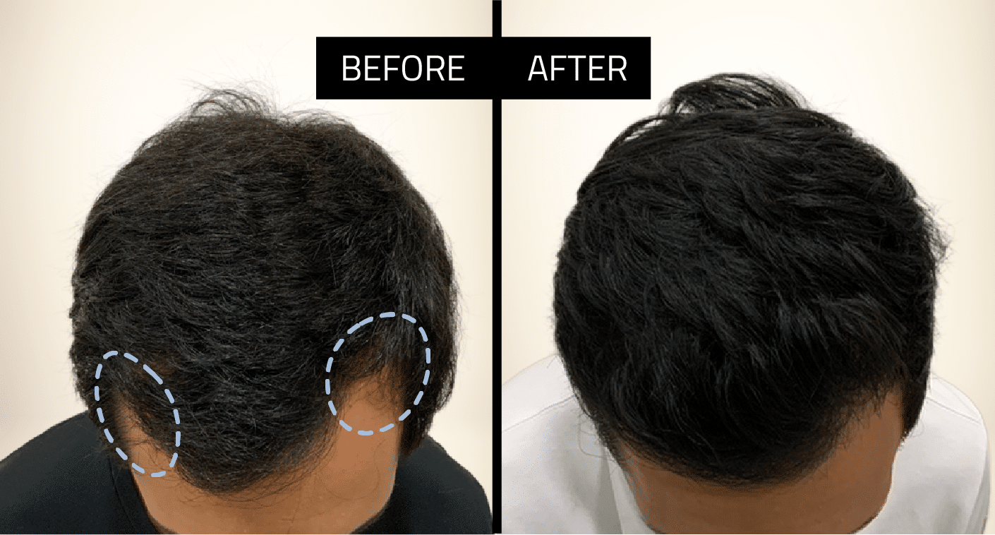 Shave-Less FUE Transformation