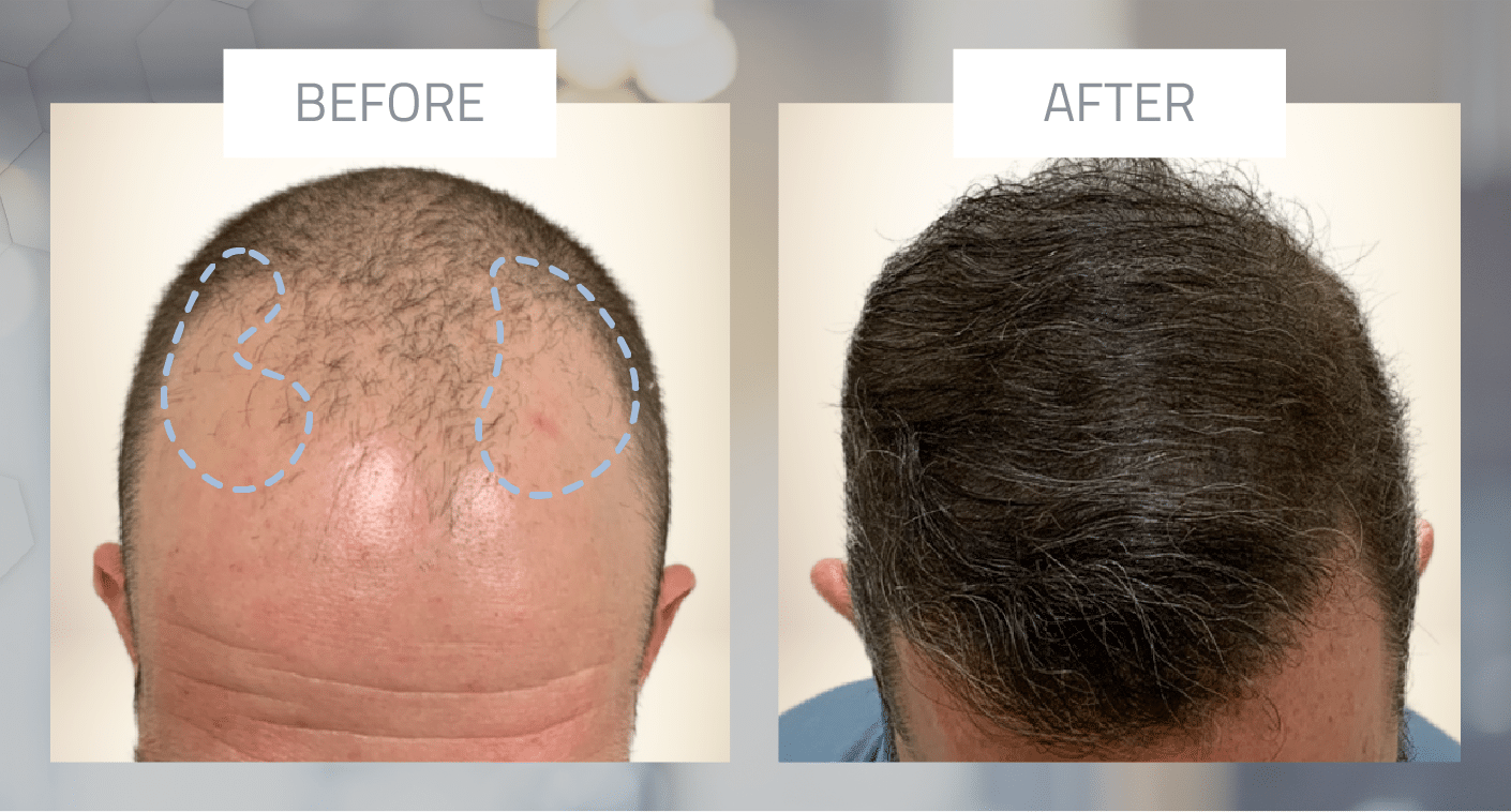 FUE Hair Restoration