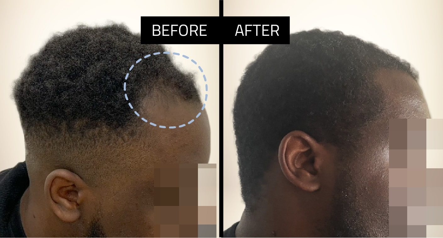 african american hair restoration before and after