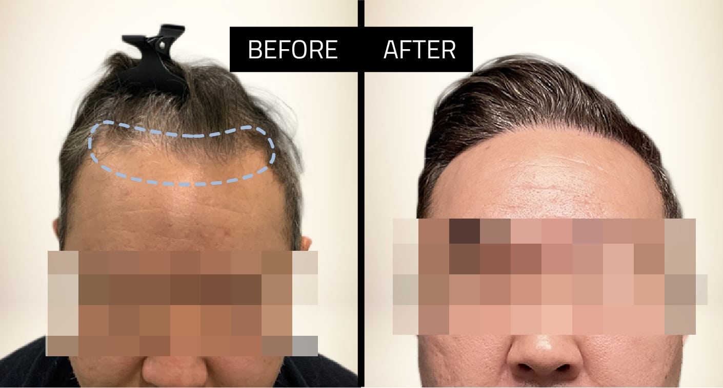 before and after shave-less fue