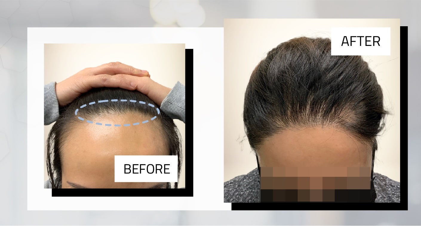 female before and after hair transplant