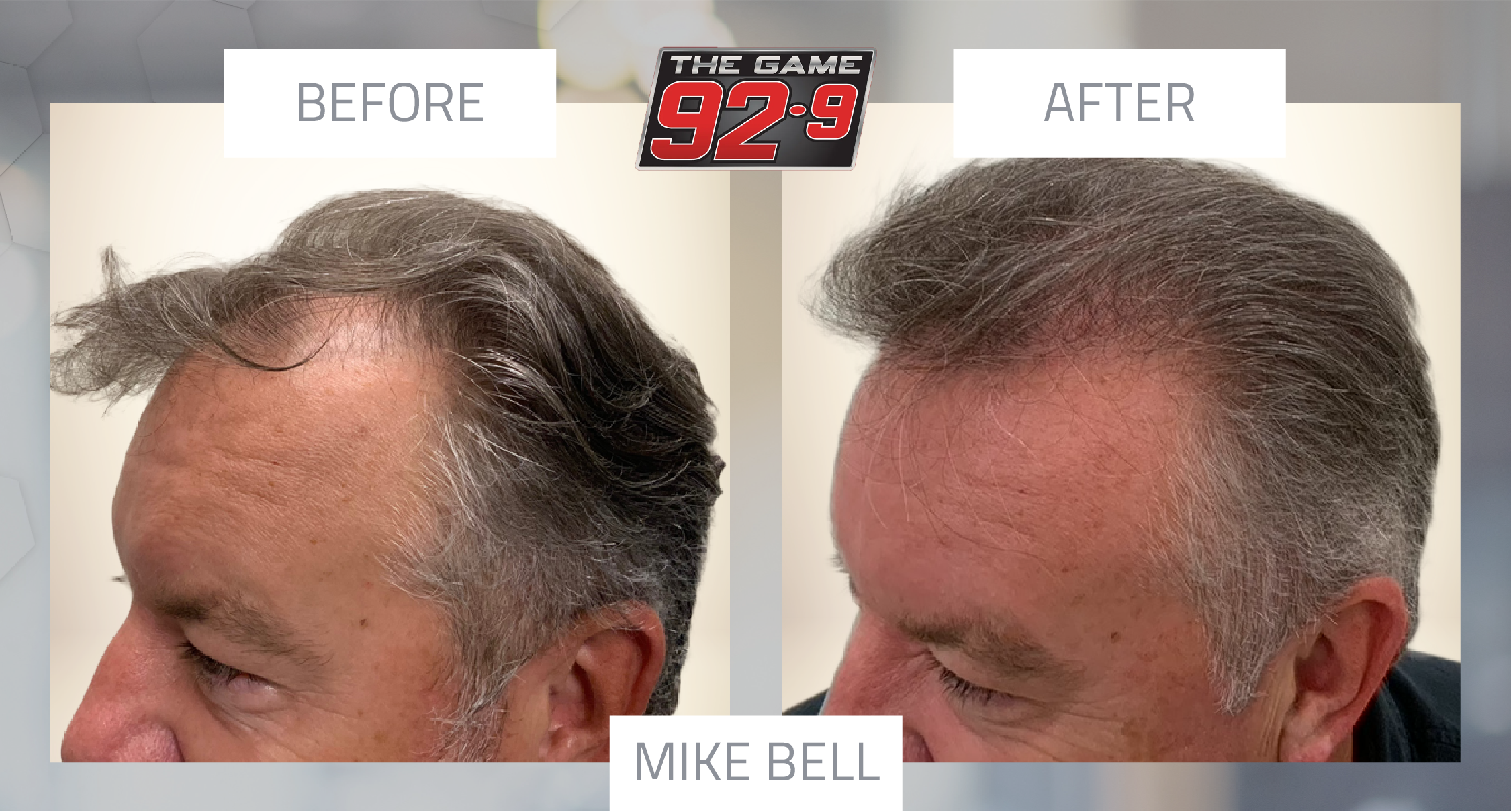 Mike Bell hair restoration