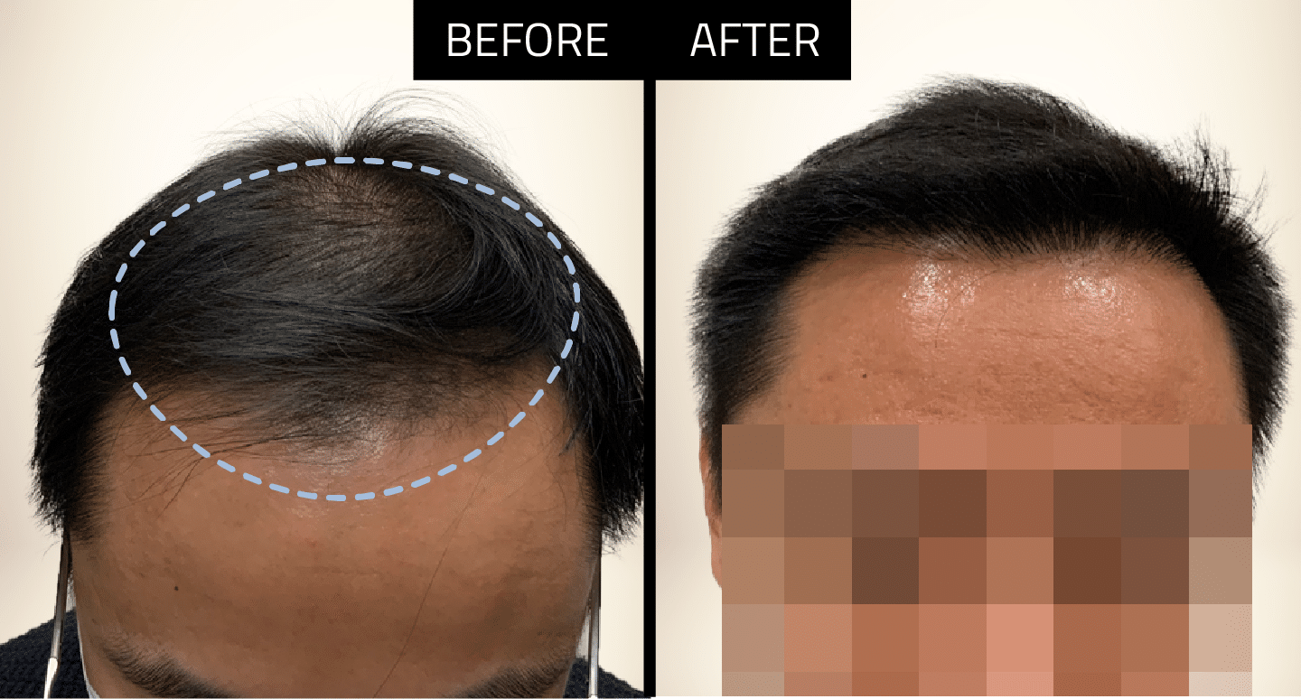 DHI Hair Transplant Success - 1