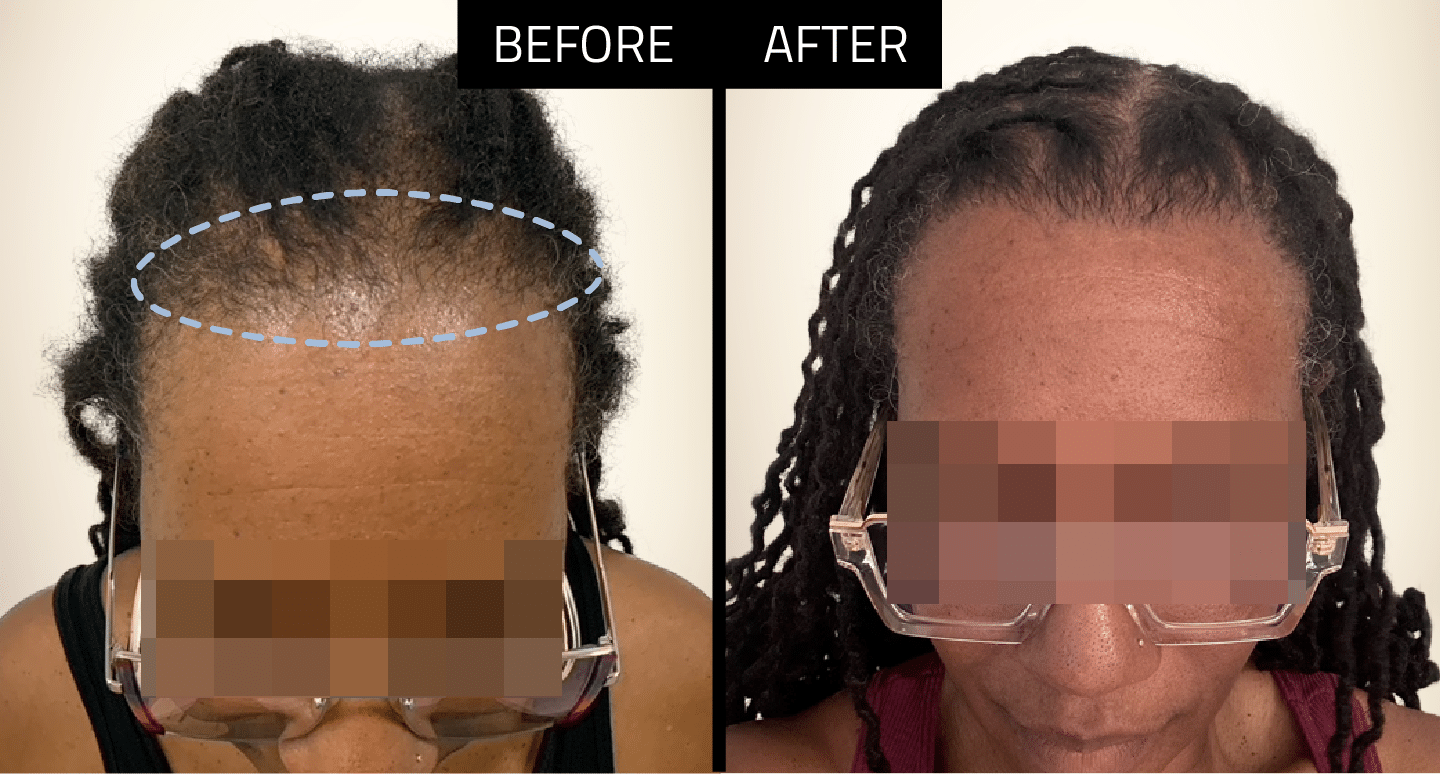 DHI Hair Transplant Success - 2