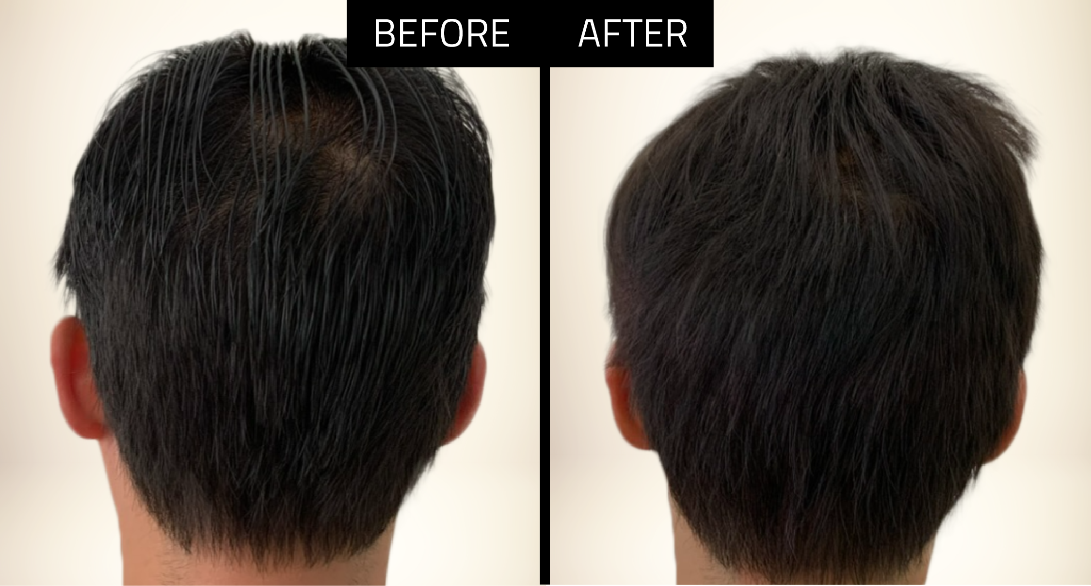 ong-hair-transplant-before-and-after-3