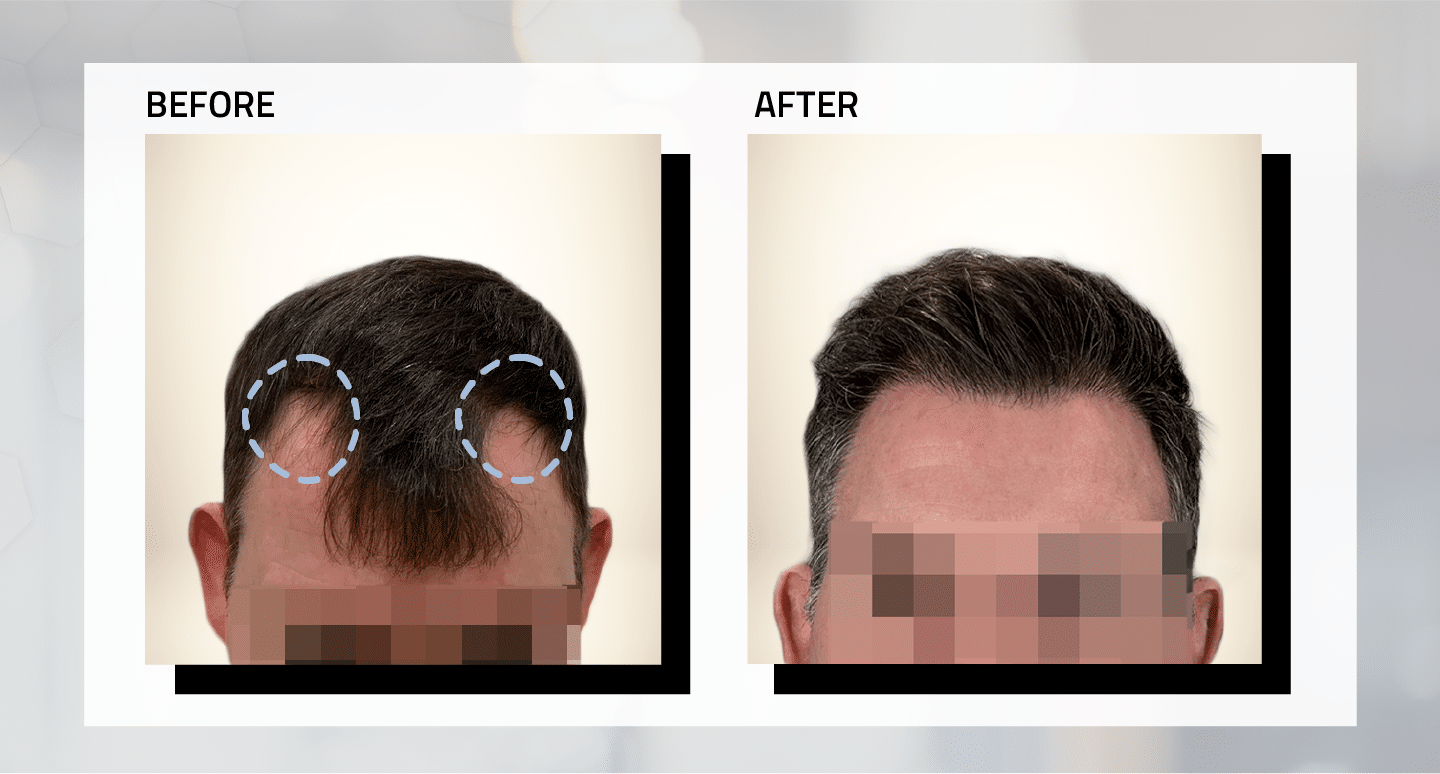 ong-hair-transplant-before-and-after-4