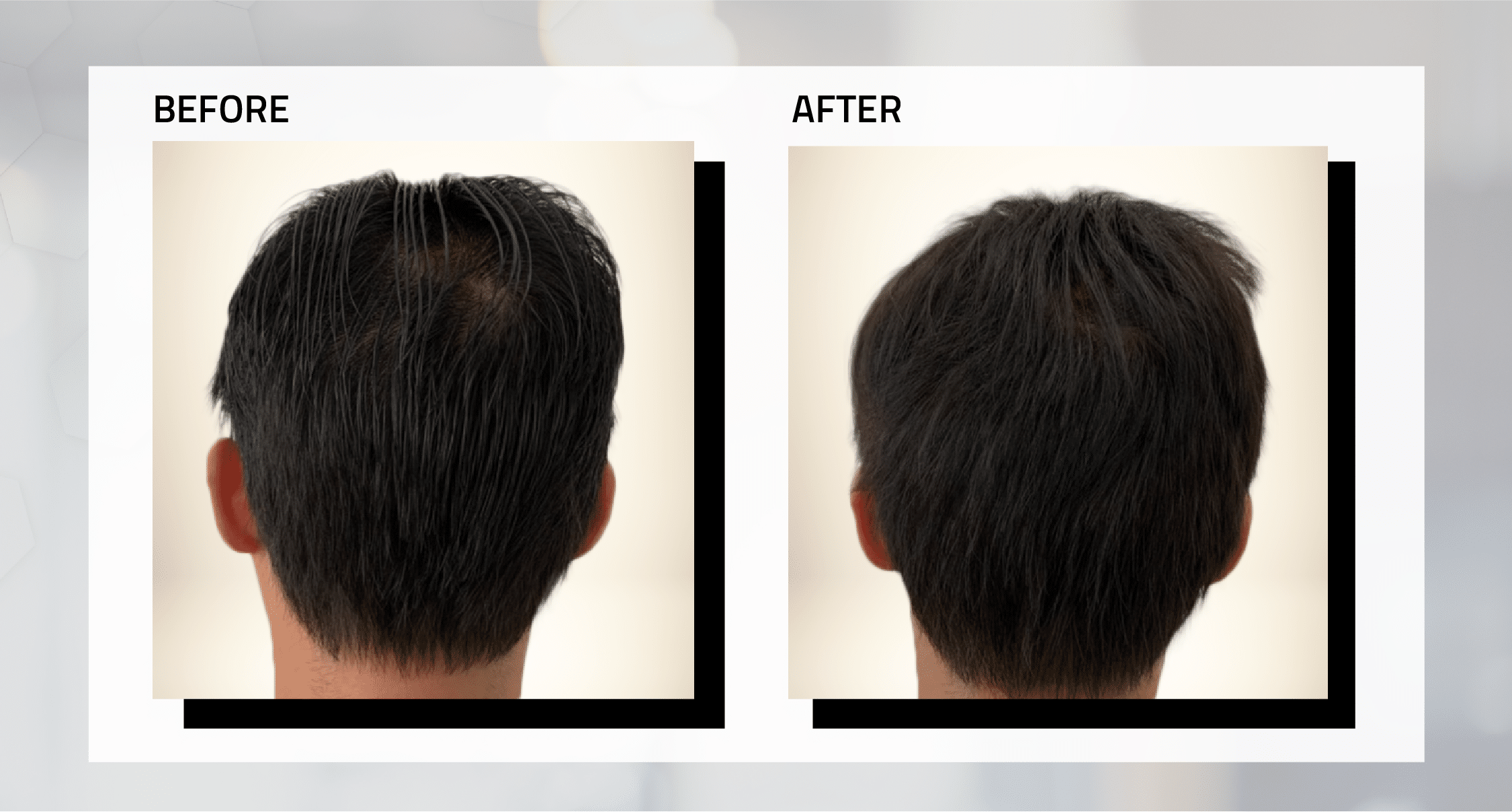 ong-hair-transplant-before-and-after-6