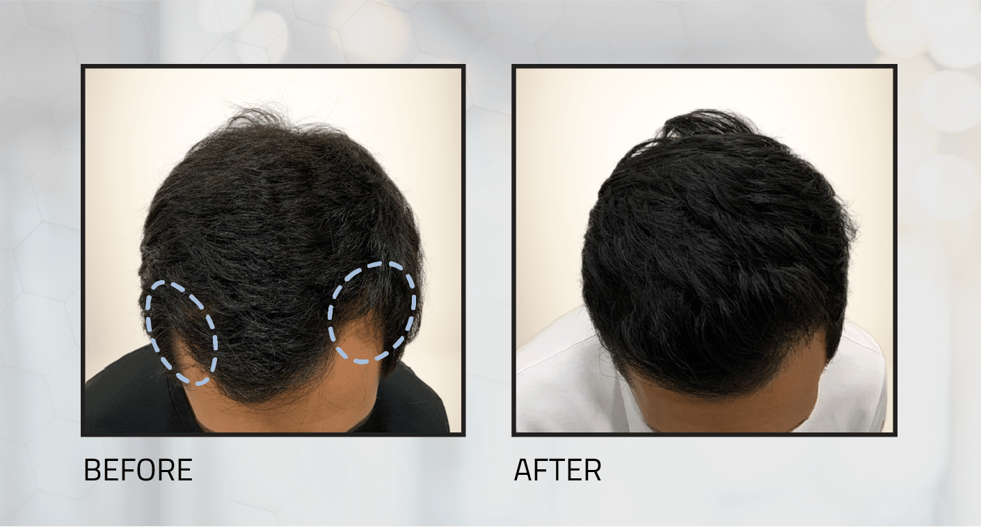 ong-hair-transplant-before-and-after-7