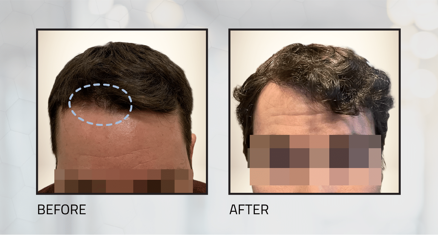 long-hair-transplant-before-and-after-8