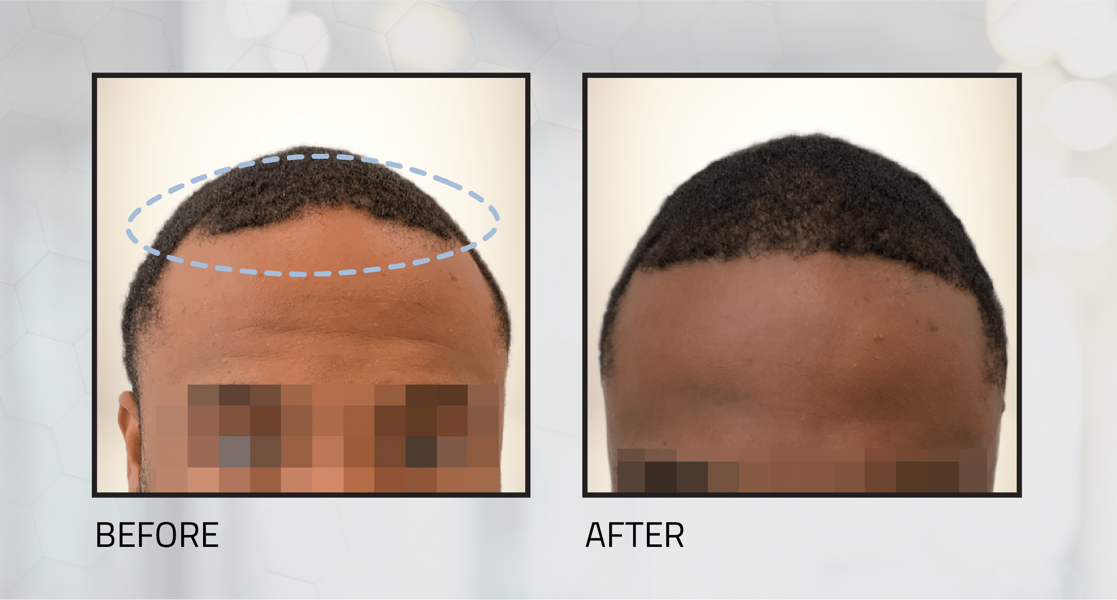 shaveless-fue-before-and-after