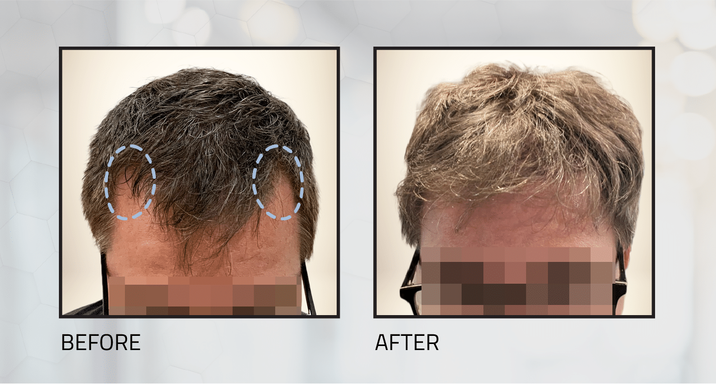 Shave-Less FUE Hair Transplants