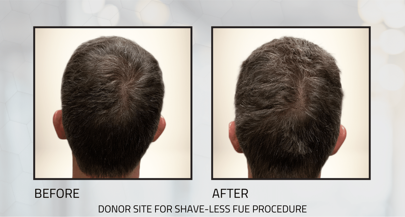 Understanding Shave-Less FUE