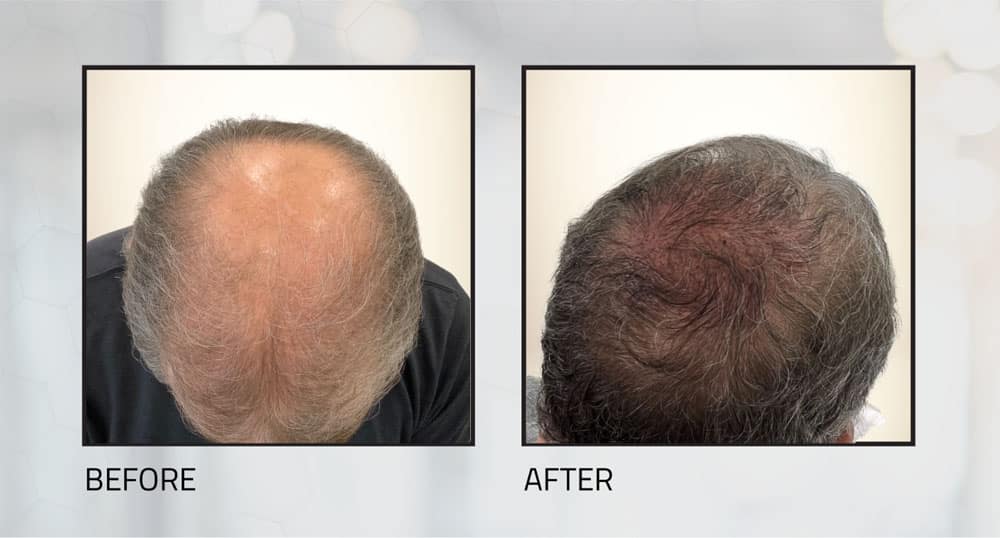 Hair Restoration Transformation